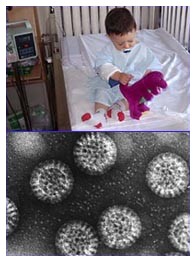 Gastroenterite bambini e vaccino per il rotavirus Gastroenterite bambini