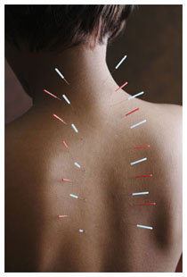 Agopuntura: punti che cambiano la percezione del dolore