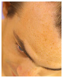 Alopecia capelli: cura della calvizie Alopecia capelli: cura della calvizie