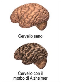 Alzheimer: pi rischi per le donne