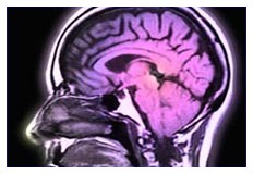 Alzheimer e diabete forse sono legati