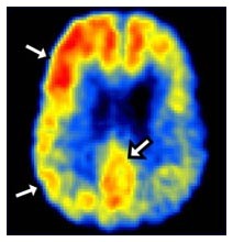 Alzheimer: test genetico Alzheimer: test genetico