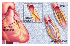 Angioplastica, efficace anche dopo 12 ore Angioplastica, efficace anche dopo 12 ore