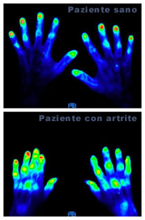 Artrite reumatoide, sintomi e trattamento