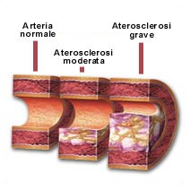 Aterosclerosi e statina