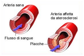 Ormone salva arterie e aterosclerosi