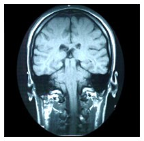 Aumentare l'intelligenza con controindicazioni