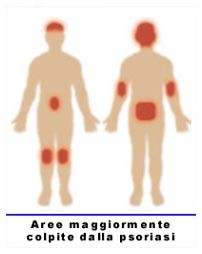 Psoriasi: campagna di informazione Psoriasi: campagna di informazione