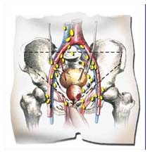 Cancro alla prostata Cancro alla prostata