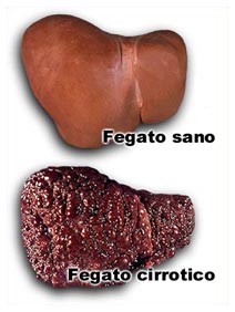 Cirrosi epatica e complicanze Cirrosi epatica e complicanze