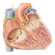 trapianto di cuore artificiale