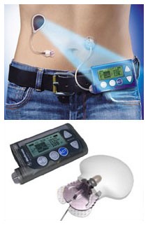 Diabete: pancreas artificiale