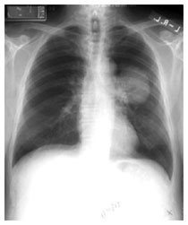 Diagnosi tumore polmone: TAC spirale