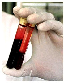 Alternativa alla donazione di sangue Alternativa alla donazione di sangue