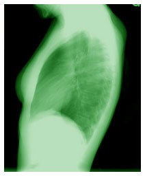 Terapia genetica per la fibrosi cistica Terapia genetica per la fibrosi cistica