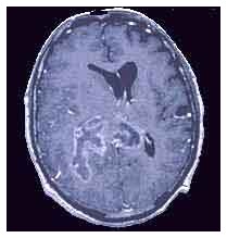 DNA e cancro al cervello DNA e cancro al cervello
