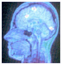 Nuovi neuroni dopo un ictus Nuovi neuroni dopo un ictus
