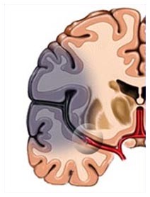Ischemia cerebrale: prevenire i danni con una terapia