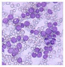 Leucemia acuta nei bambini: un nuovo farmaco