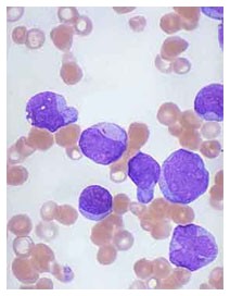 Leucemia: una possibile cura