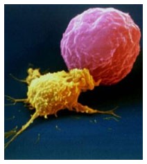 Leucemia: cura dalle cellule del cordone ombelicale