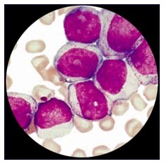 Leucemia Mieloide: trovata una cura