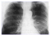 Malattie respiratorie: in crescita i morti