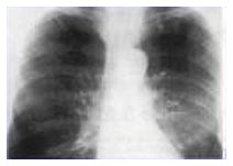 Malattie respiratorie: in crescita i morti Malattie respiratorie: in crescita i morti