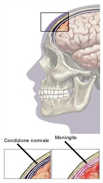 Meningite: come riconoscere i primi sintomi?