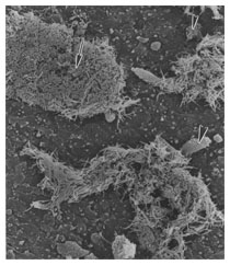 Sclerosi multipla, diabete di tipo 1 e Mycobacterium avium Sclerosi multipla, diabete di tipo 1 e Mycobacterium avium