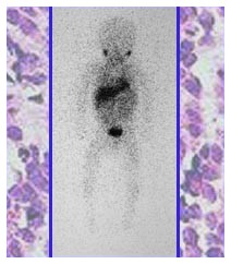 Neuroblastoma: nuova cura sperimentale dal Gaslini Neuroblastoma: nuova cura sperimentale dal Gaslini