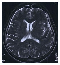 Neurologia: cura della sclerosi multipla
