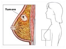 Nuovo studio sul cancro al seno