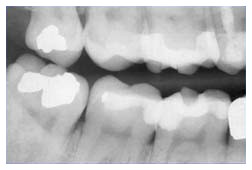 Nuove otturazioni per denti Nuove otturazioni per denti