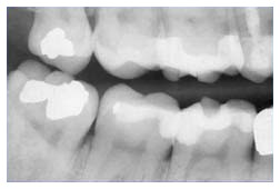 Nuove otturazioni per denti