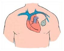 Un nuovo pacemaker più sicuro Un nuovo pacemaker più sicuro