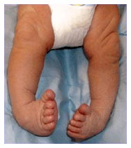 Piede torto congenito Piede torto congenito