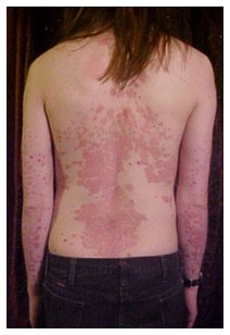 Psoriasi e disaggio psicologico Psoriasi e disaggio psicologico