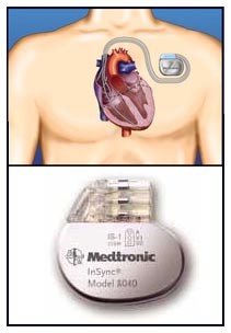 Resincronizzazione cardiaca: meno decessi per scompenso cardiaco