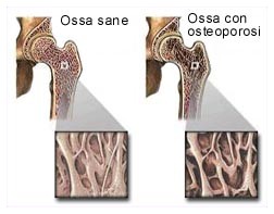 Sei a rischio di osteoporosi ?