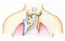 Tiroide, meno rischi post-operazione Tiroide, meno rischi post-operazione
