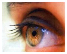 Trapianto di cornea con l'ausilio del solo laser