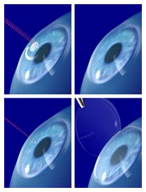 Trapianto di cornea: laser a femtosecondi