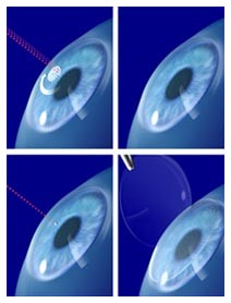 Trapianto di cornea: laser a femtosecondi Trapianto di cornea: laser a femtosecondi