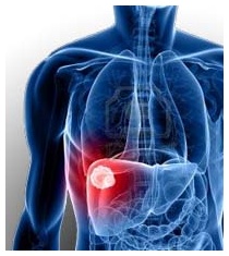 Tumore al fegato: diagnosi e prevenzione Tumore al fegato: diagnosi e prevenzione