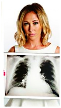Tumore al polmone: diagnosi con analisi del sangue