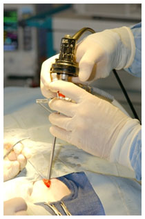 Tumore vescica: diagnosi con esame delle urine Tumore vescica: diagnosi con esame delle urine