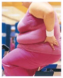 Tumore alle ovaie e obesità Tumore alle ovaie e obesità