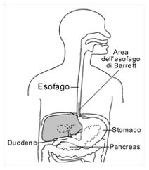 Tumore all'esofago: effetto preventivo dell'aspirina