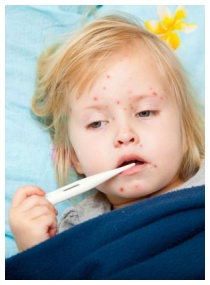Foto morbillo